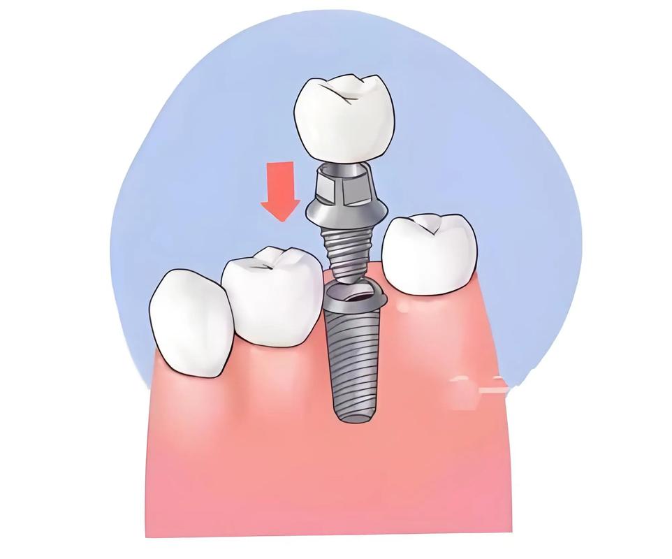 种牙第四期过程疼不疼？-图2