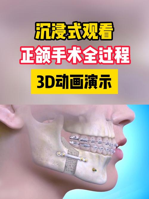 上颌斜导在口腔正畸中制作的关键步骤和材料选择是什么?-图3 上颌斜导在口腔正畸中制作的关键步骤和材料选择是什么?-图3