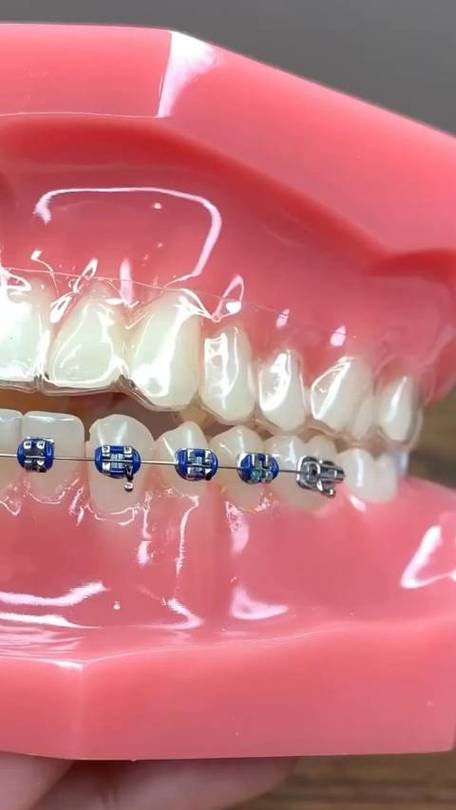 正畸蜡怎么用？正确使用步骤与注意事项详解？-图3