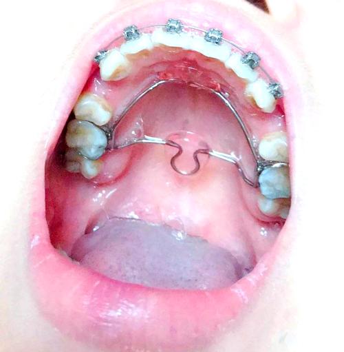 牙齿矫正正畸过程图片-图1 牙齿矫正正畸过程图片-图1