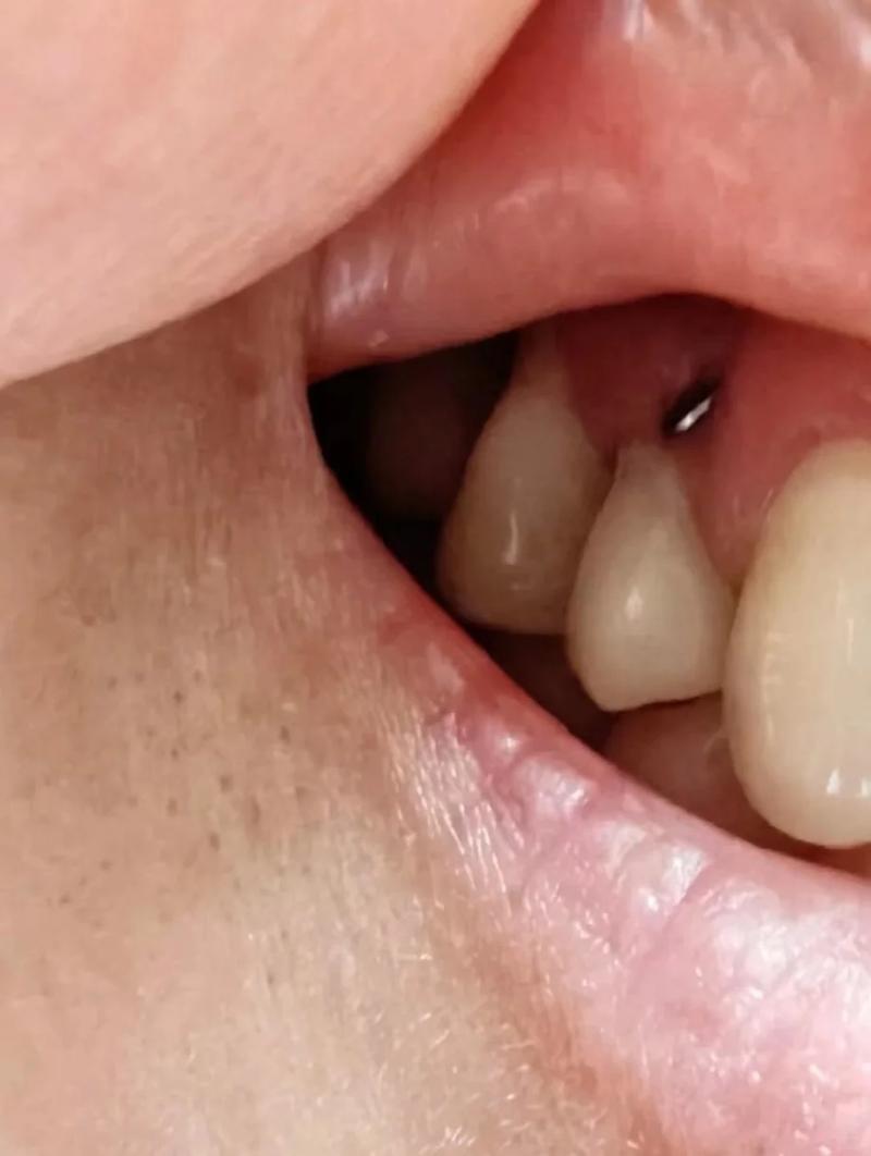 牙齿少一颗种牙-图3