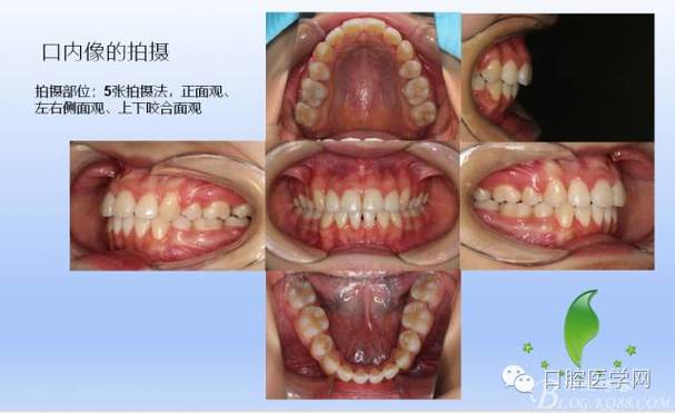 口腔正畸照片拍摄要点-图2