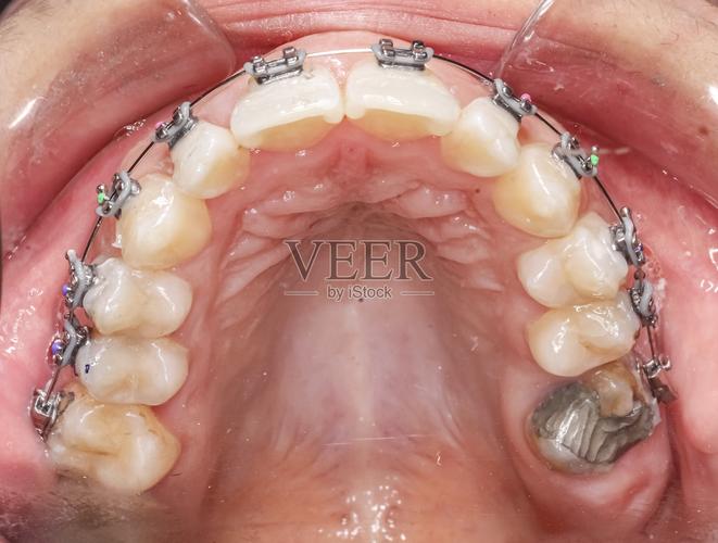 口腔正畸照片拍摄要点-图3