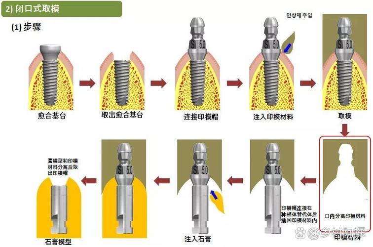 种牙要取幾次模-图1