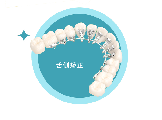 舌侧矫正方法-图3