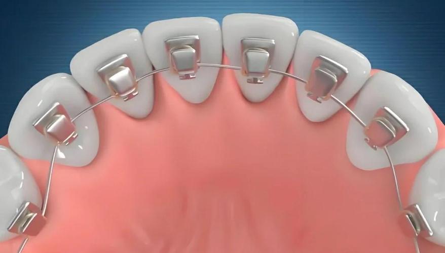 舌侧矫正方法-图1