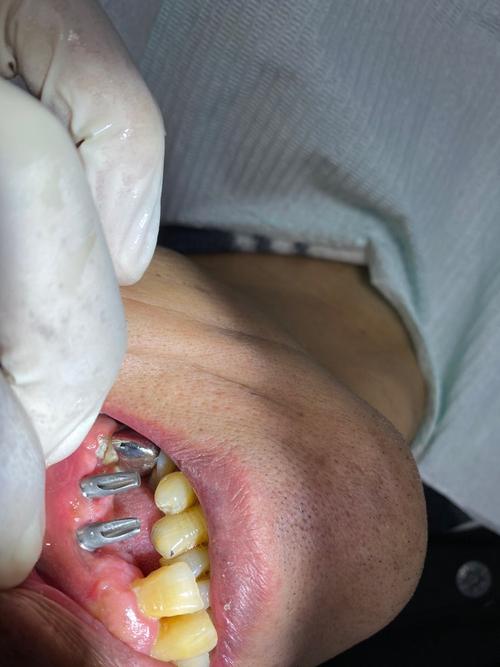 种牙一年后失败?是医生技术、材料质量还是自身原因?-图1 种牙一年后失败?是医生技术、材料质量还是自身原因?-图1