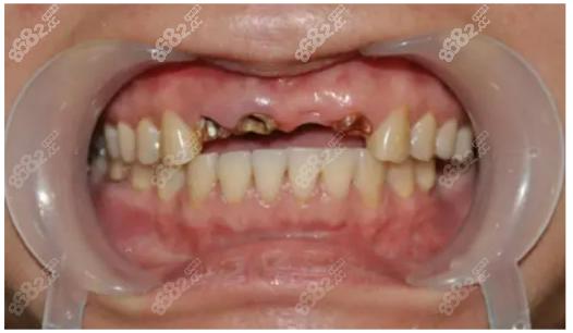种牙一年后失败?是医生技术、材料质量还是自身原因?-图3 种牙一年后失败?是医生技术、材料质量还是自身原因?-图3
