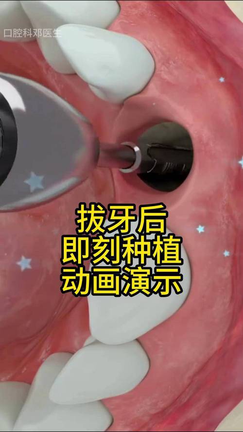 牙傅士即拔即种-图3