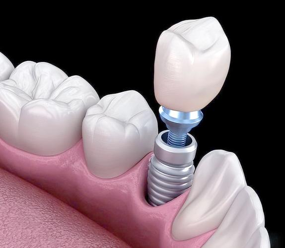 种牙种植体纯钛-图1 种牙种植体纯钛-图1