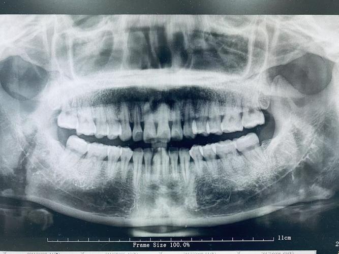 牙科摄片方法-图3