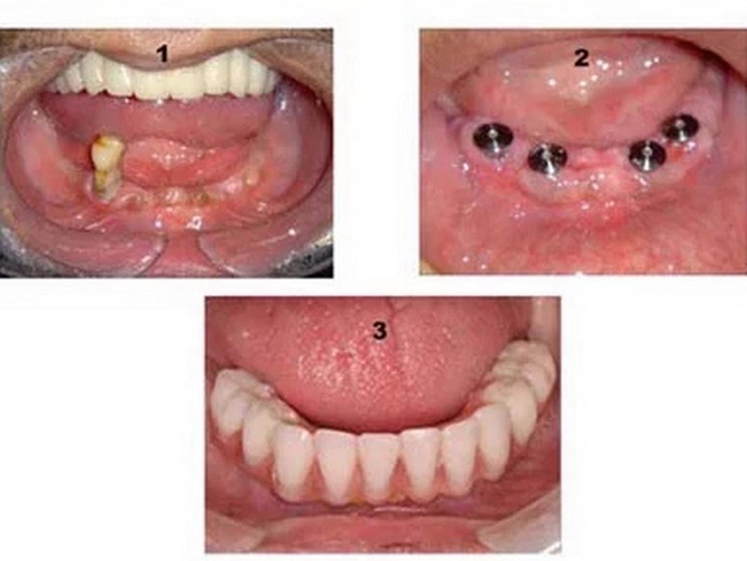 糖尿病能种牙吗-图1