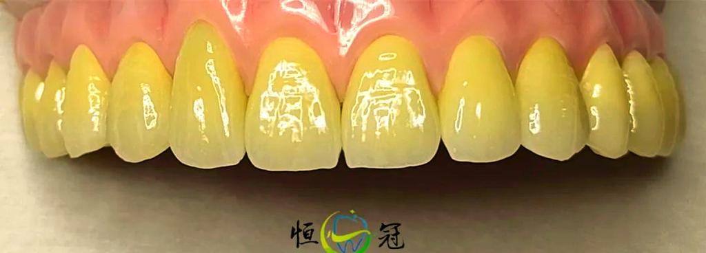 牙体抛光方法-图2