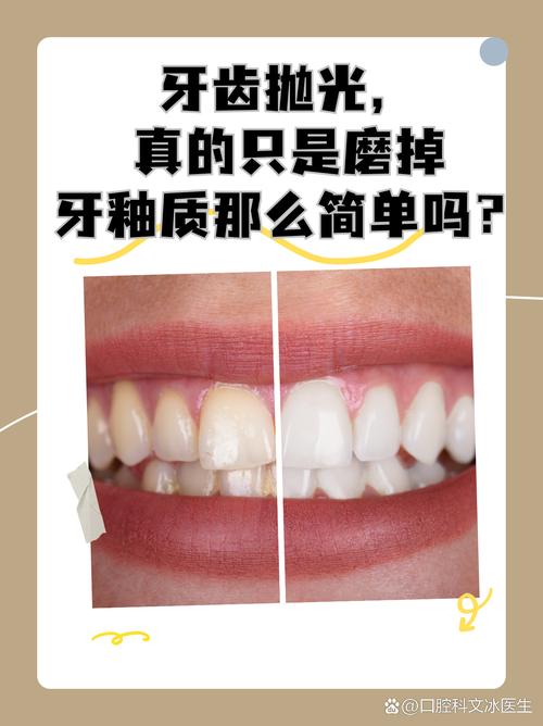 牙体抛光方法-图1