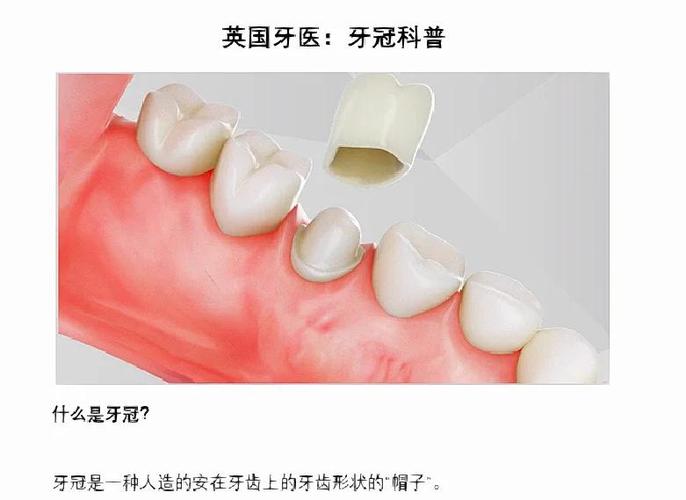 牙齿戴冠的方法有哪些？详细步骤和注意事项是什么？-图3