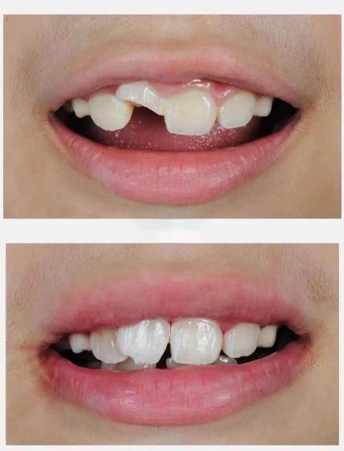 断牙再接方法-图1