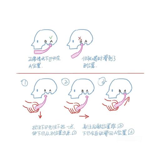 锁颌解除方法-图1