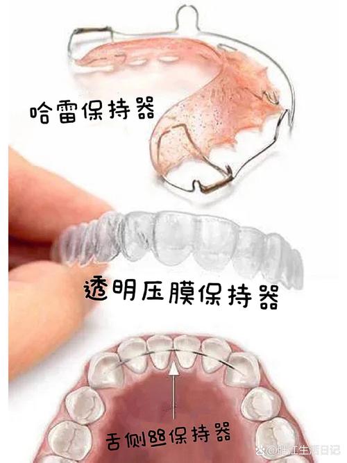 正畸保持器的制作步骤-图3