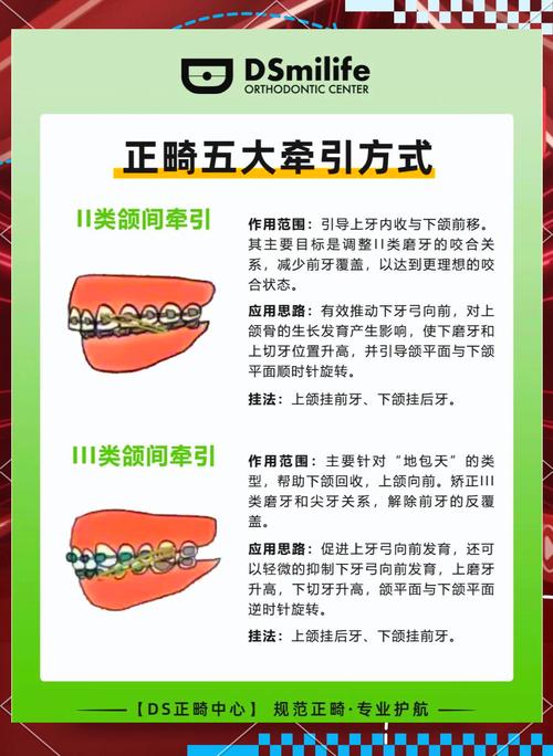 正畸闭隙方法有哪些？不同方法适用哪些情况？-图3