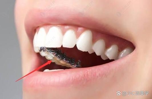 MBT直丝弓隐形正畸适合哪些牙齿问题矫正？-图3