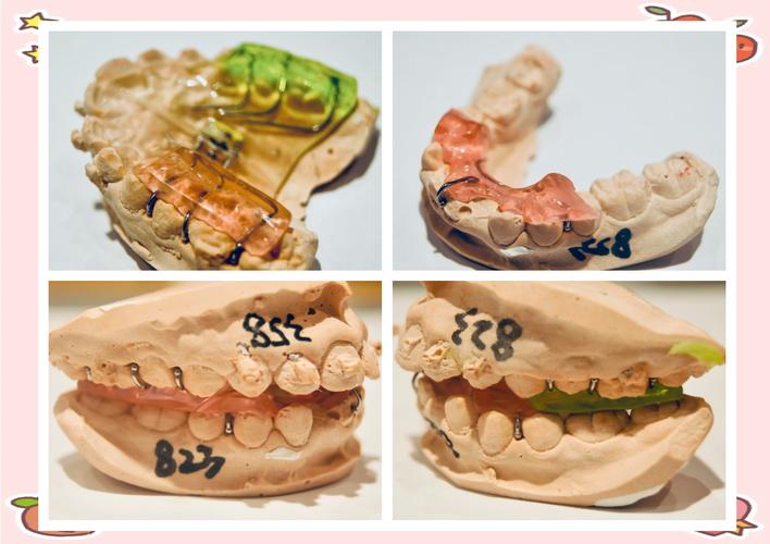 MBT直丝弓隐形正畸适合哪些牙齿问题矫正？-图1