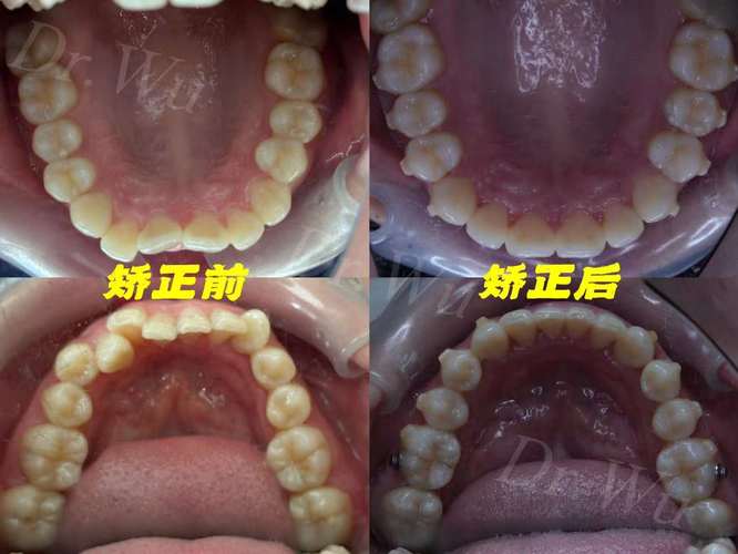 MBT直丝弓隐形正畸适合哪些牙齿问题矫正？-图2