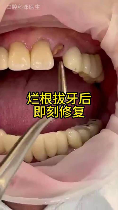 种牙后还会掉吗？种植牙脱落风险与稳定性疑问解析-图3