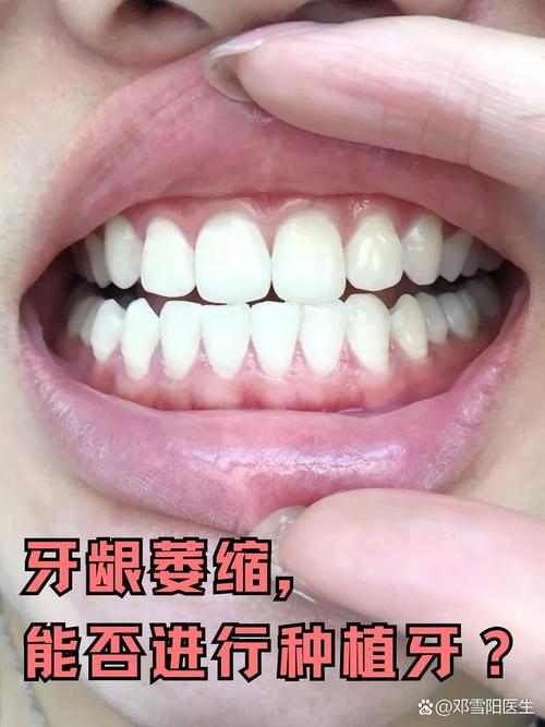 正畸后牙龈萎缩,究竟是什么原因导致的?-图3 正畸后牙龈萎缩,究竟是什么原因导致的?-图3