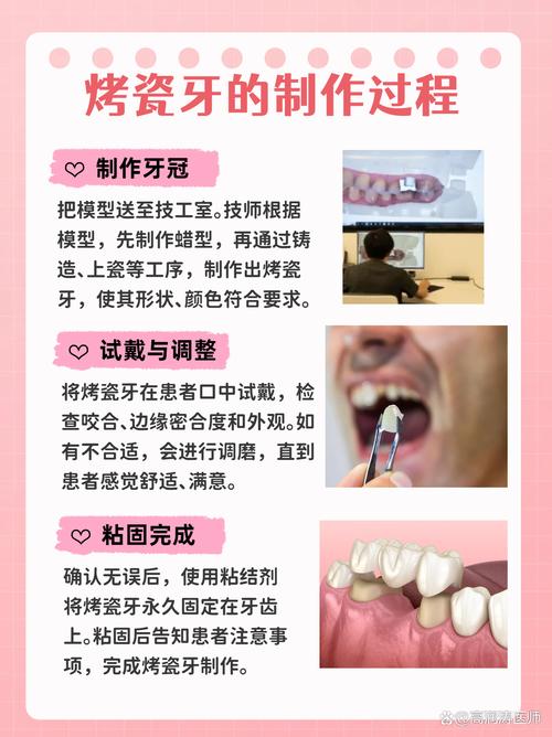 牙冠粘接方法-图2