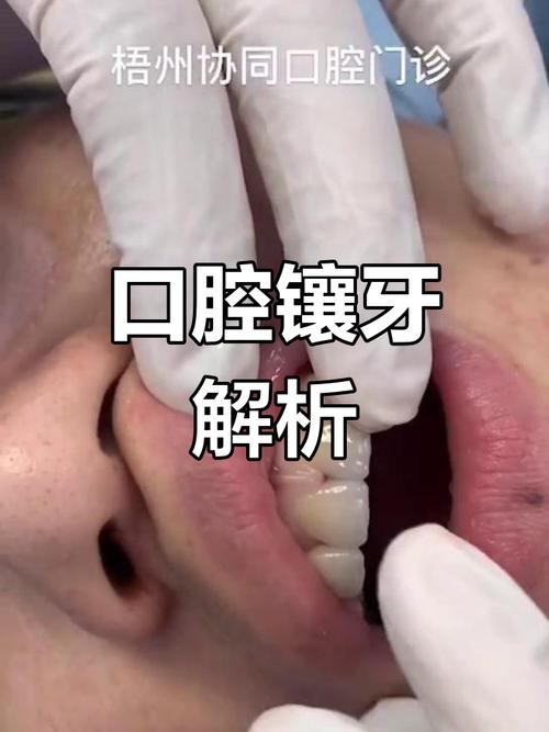 口腔雕牙方法-图3