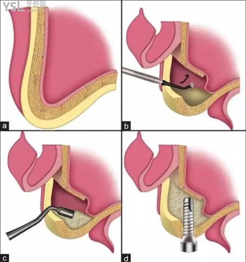 上颌手术方法-图2