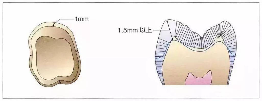 肩台预备方法-图1