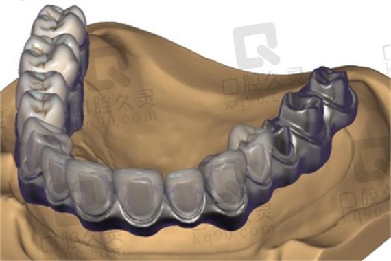 种牙桥架的应用-图1