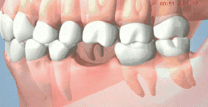 种牙过程动态图-图1