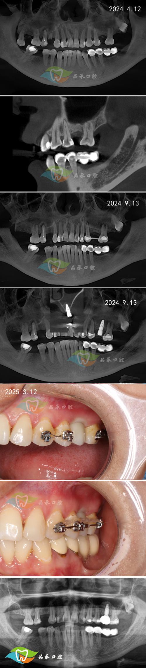 种牙后骨密度低-图3