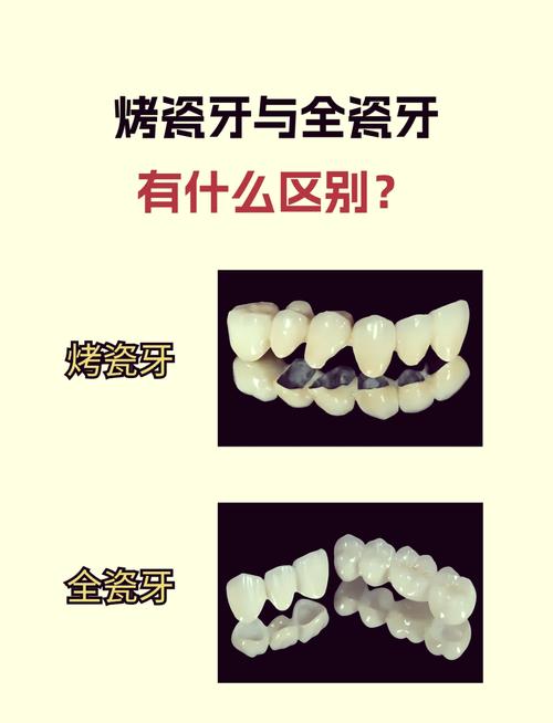 烤瓷牙种牙危害-图1 烤瓷牙种牙危害-图1