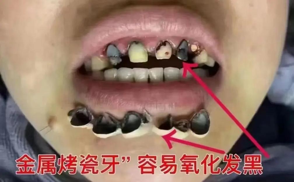 烤瓷牙种牙危害-图2 烤瓷牙种牙危害-图2