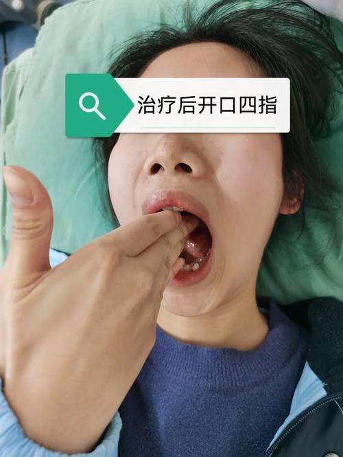 正畸治疗会影响颞下颌关节健康吗？-图1