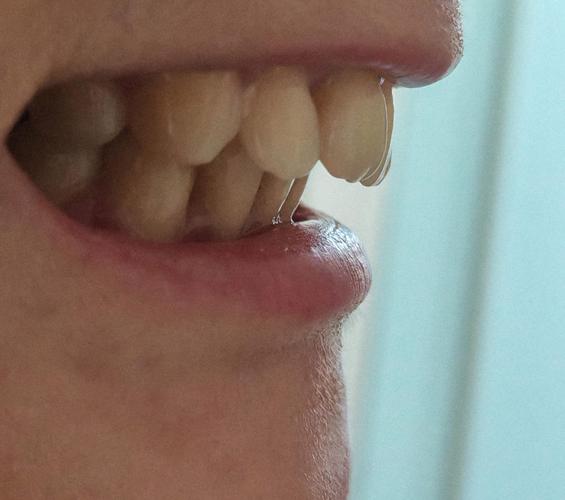 正畸治疗会影响颞下颌关节健康吗？-图3