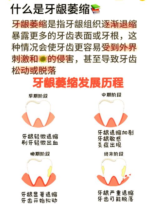 正畸期间如何有效预防牙龈萎缩？-图2