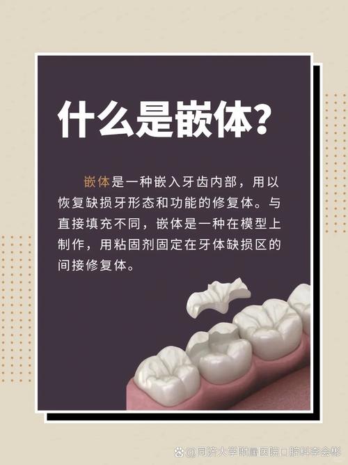 嵌体粘结方法的关键步骤是什么?-图2 嵌体粘结方法的关键步骤是什么?-图2