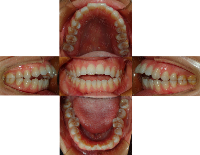 北大口腔成人正畸效果如何？适合哪些情况做？-图1