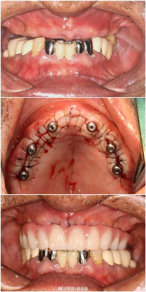 种牙半口修复贵-图2