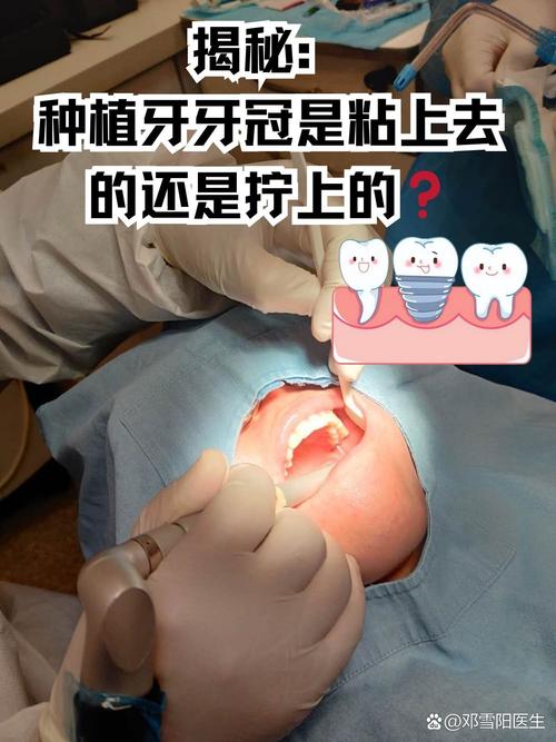 微创种牙结实吗-图2 微创种牙结实吗-图2