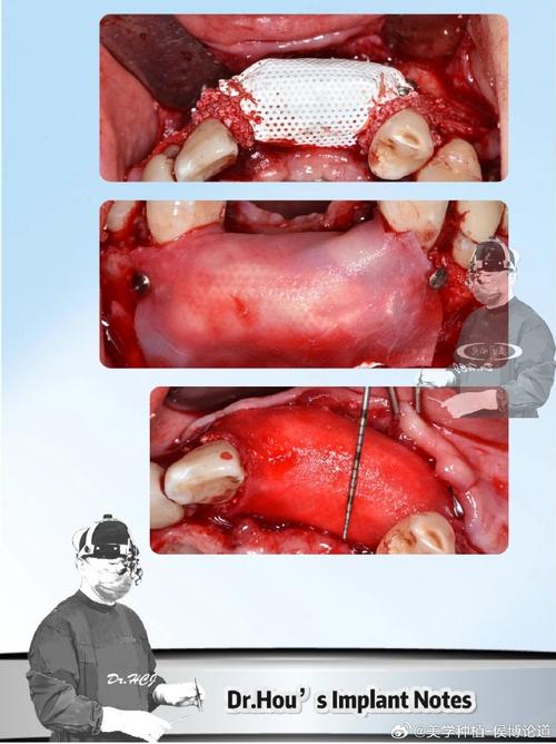 种牙为何要做游离植骨？效果和安全性如何？-图1