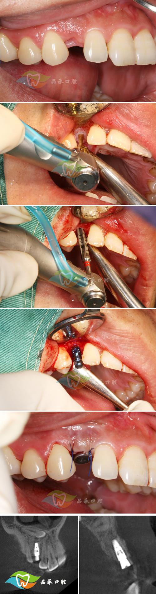 种牙为何要做游离植骨？效果和安全性如何？-图2