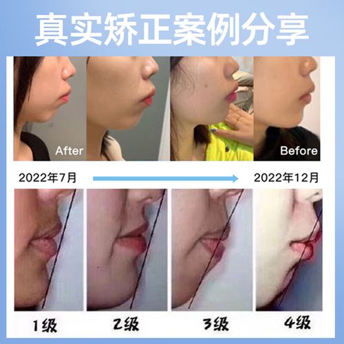 种完牙下巴青了-图3