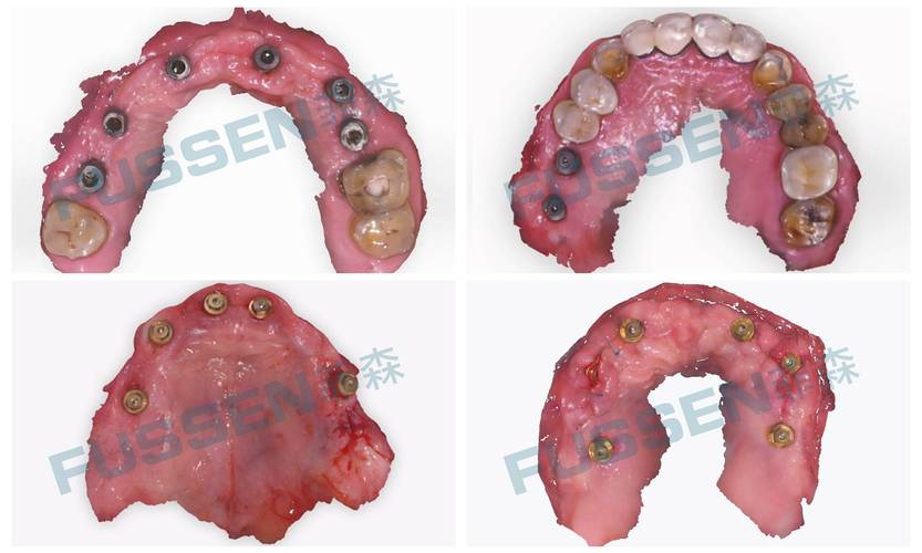 数字化种牙技术如何实现精准高效种植？-图2