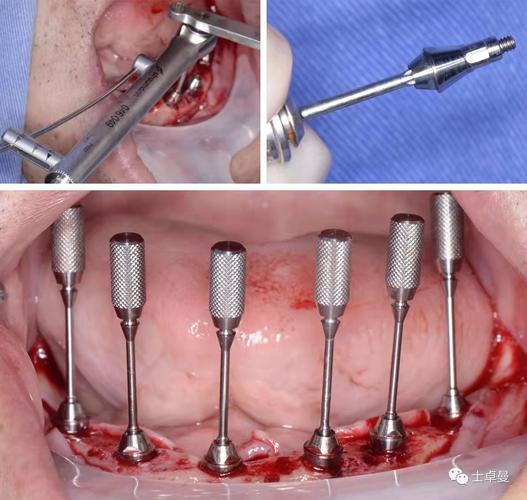 数字化种牙技术如何实现精准高效种植？-图3