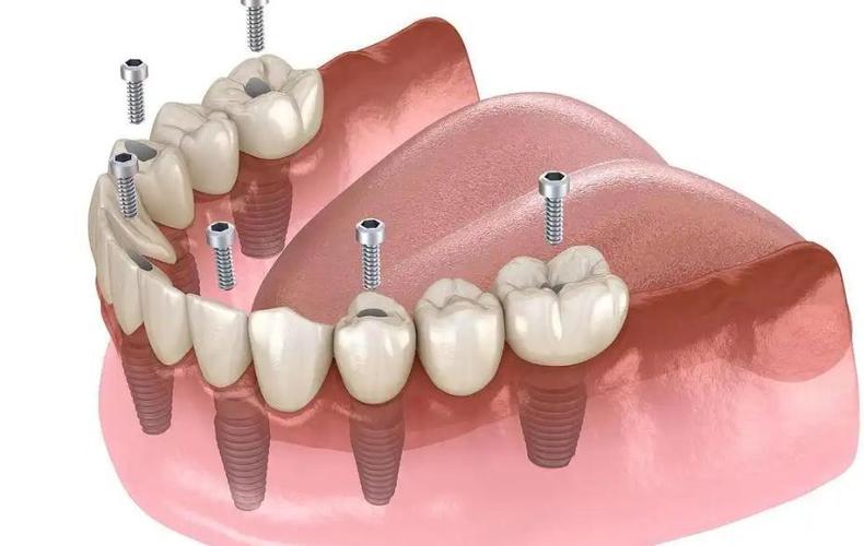 半口牙即种即用靠谱吗？当天种当天用效果如何？-图2
